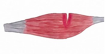 How Physiotherapy Can Help Injury Healing