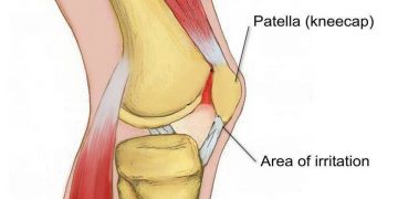 Patellofemoral Pain Syndrome